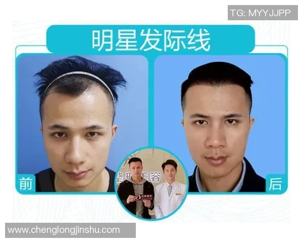 揭秘哪些足球明星选择植发重塑自信与形象